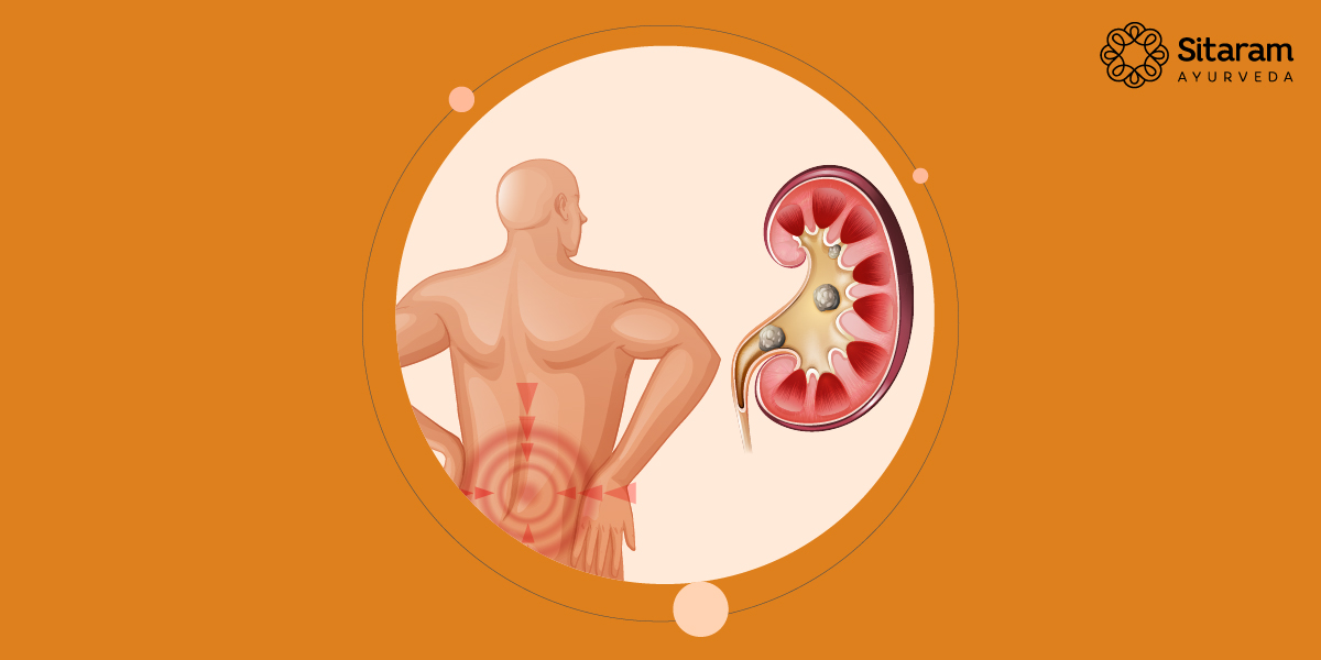 Ashmari The Ayurvedic Perspective on Kidney Stones